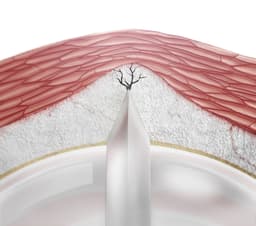 NSE PTA Aperta-PTA High Pressure Scoring Balloon Catheter